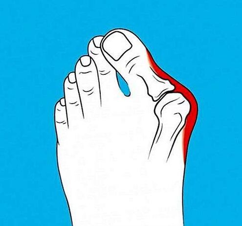kojų pirštų sąnario artrozė