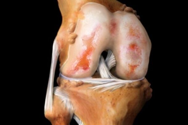kremzlės pažeidimas esant kelio sąnario artrozei