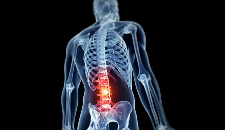 juosmeninės stuburo dalies pažeidimas sergant osteochondroze