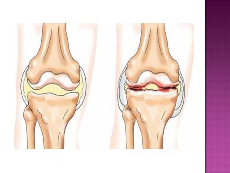 Sąnarys yra normalus (kairėje) ir pažeistas osteoartrito (dešinėje)