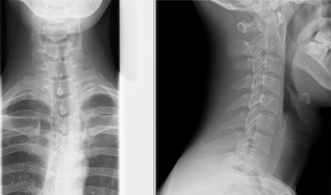 Stuburo rentgenograma yra paprastas ir efektyvus osteochondrozės diagnostikos metodas