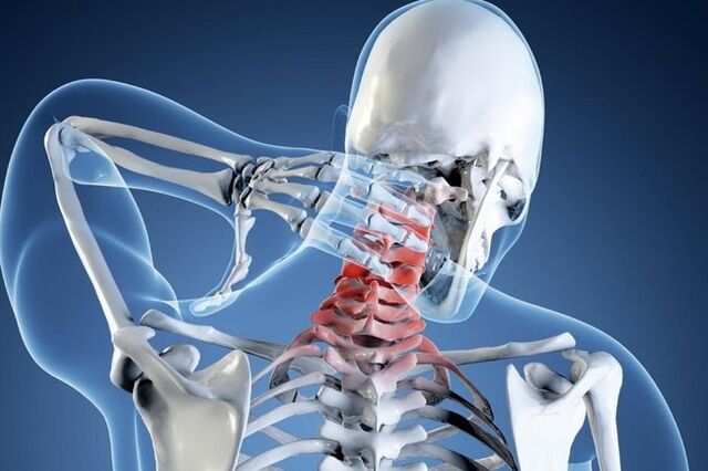 kaklo stuburo osteochondrozė